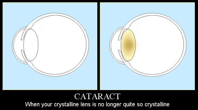 Cataract affecting the crystalline lens